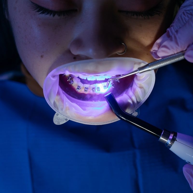 Teeth Bridges