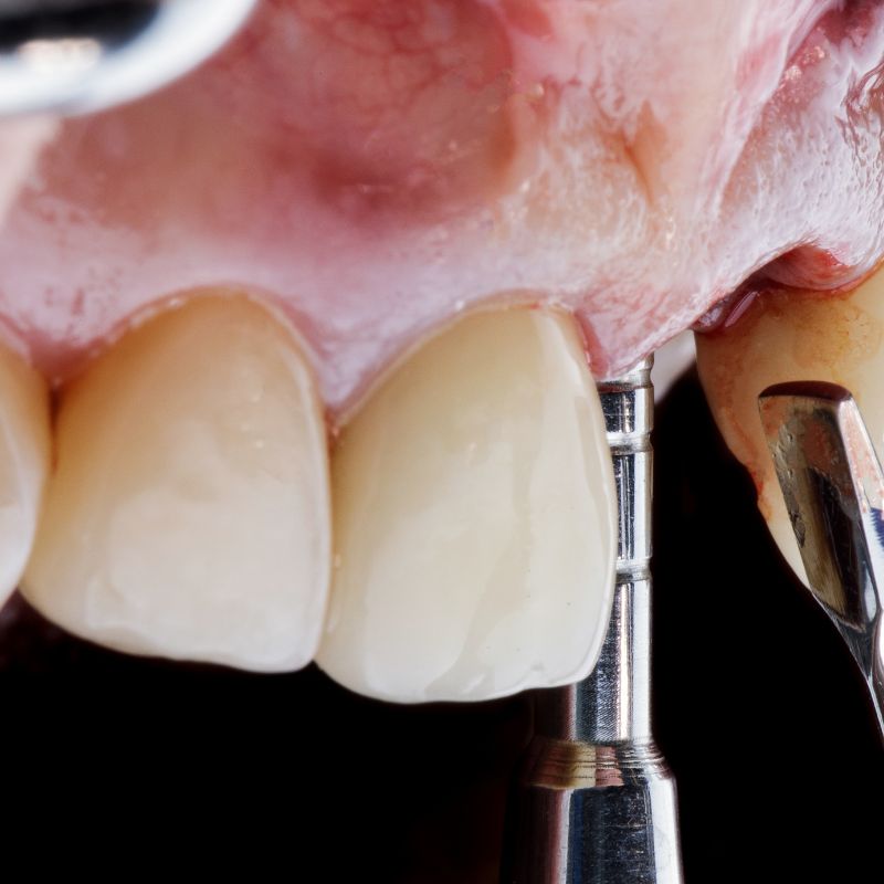 Teeth Extraction