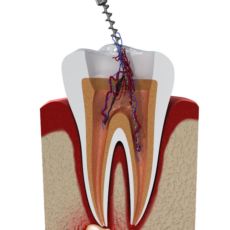 Dental mouth guard for protection