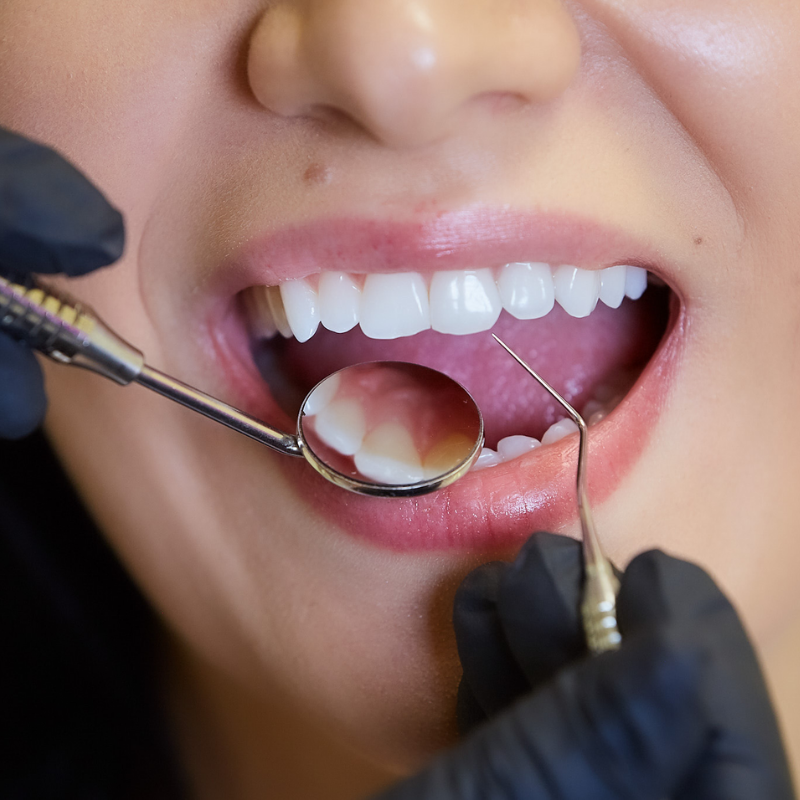 Dental mouth guard for protection