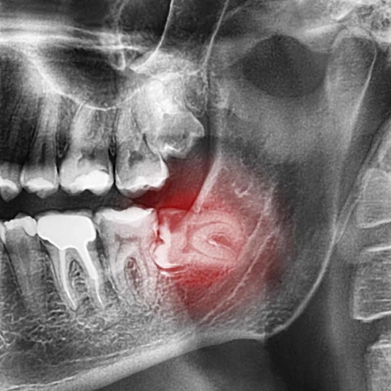 Dental mouth guard for protection