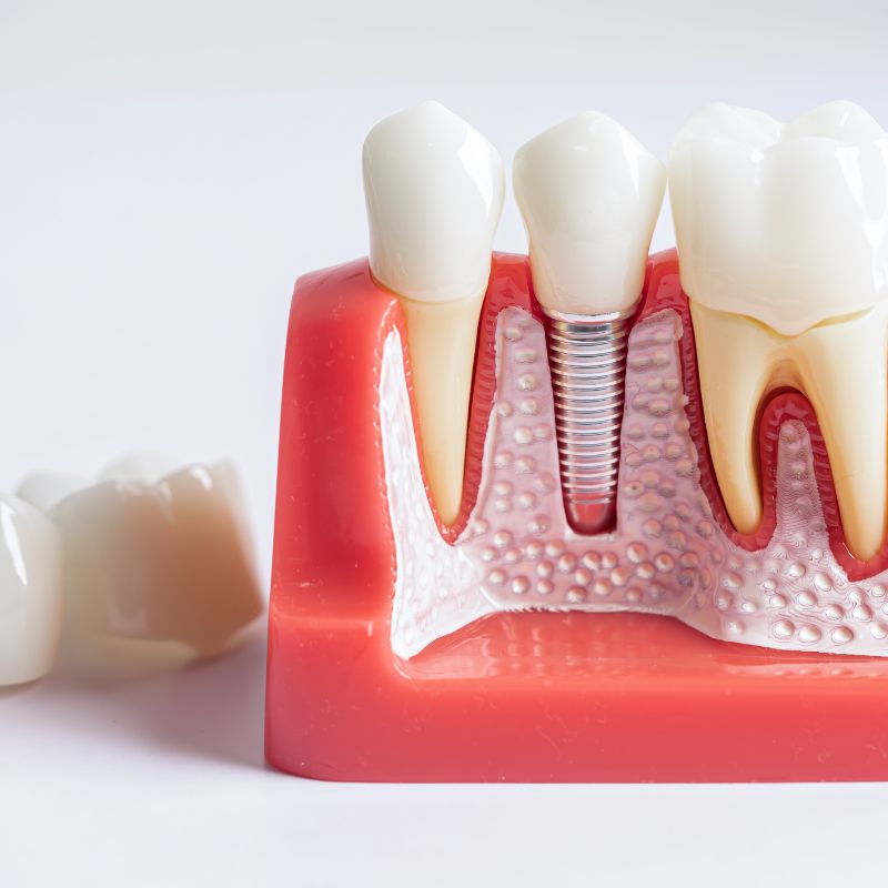 Azad Dentals dental bridge A smiling man sits in a dental chair