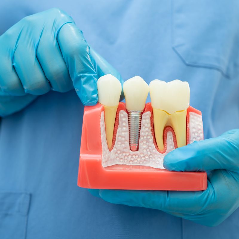 Dental mouth guard for protection
