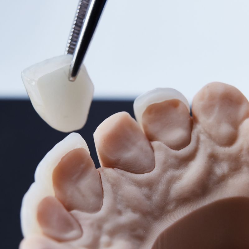 Dental mouth guard for protection