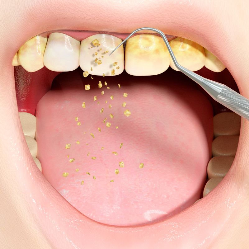 Dental mouth guard for protection