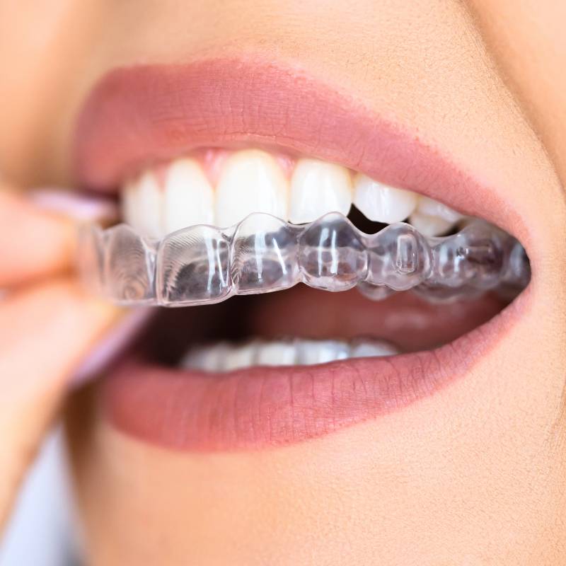 Night-guard-to-prevent-bruxism