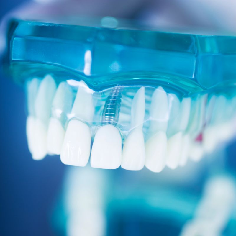 Dental mouth guard for protection