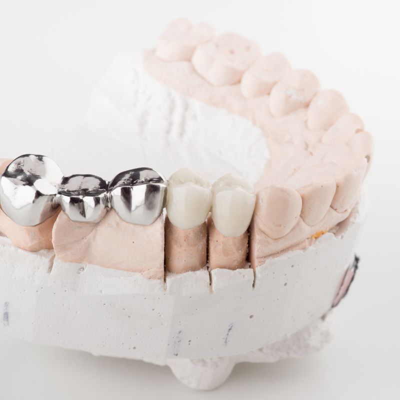 tooth filling