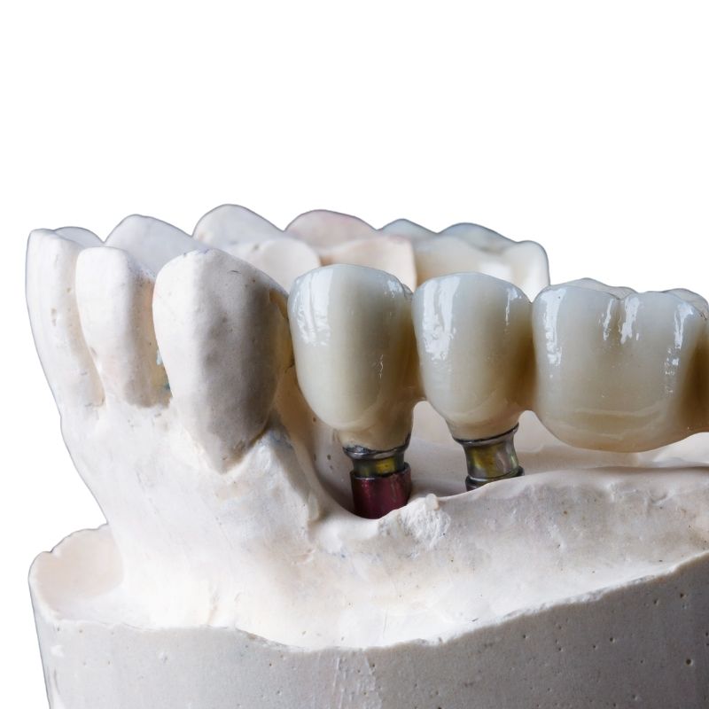 tooth filling