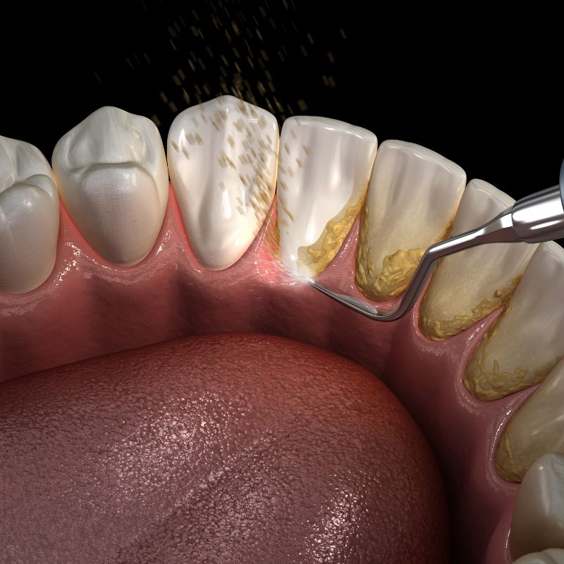 Dental mouth guard for protection