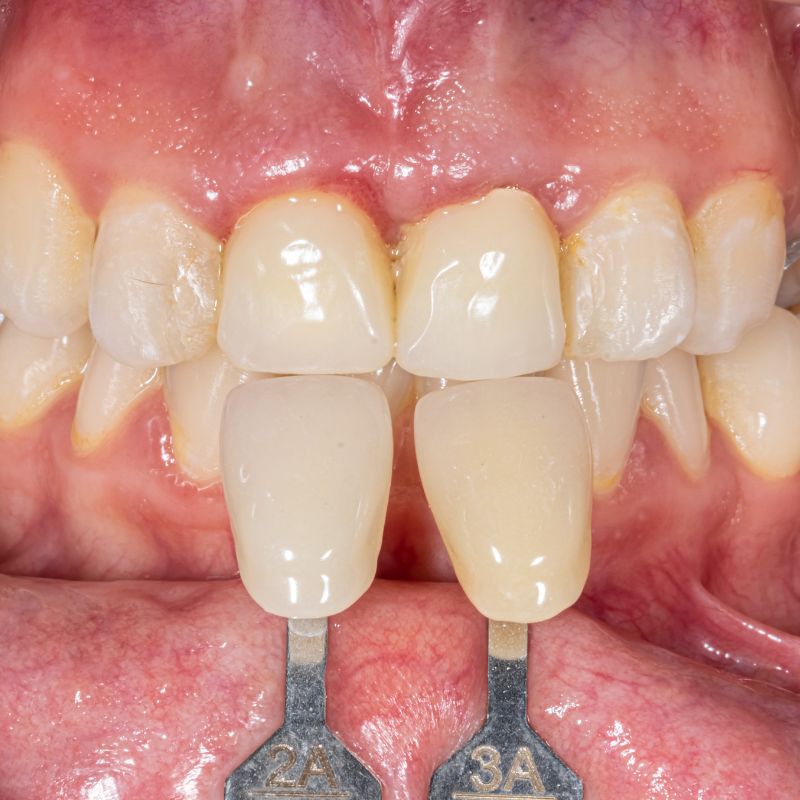 Dental mouth guard for protection