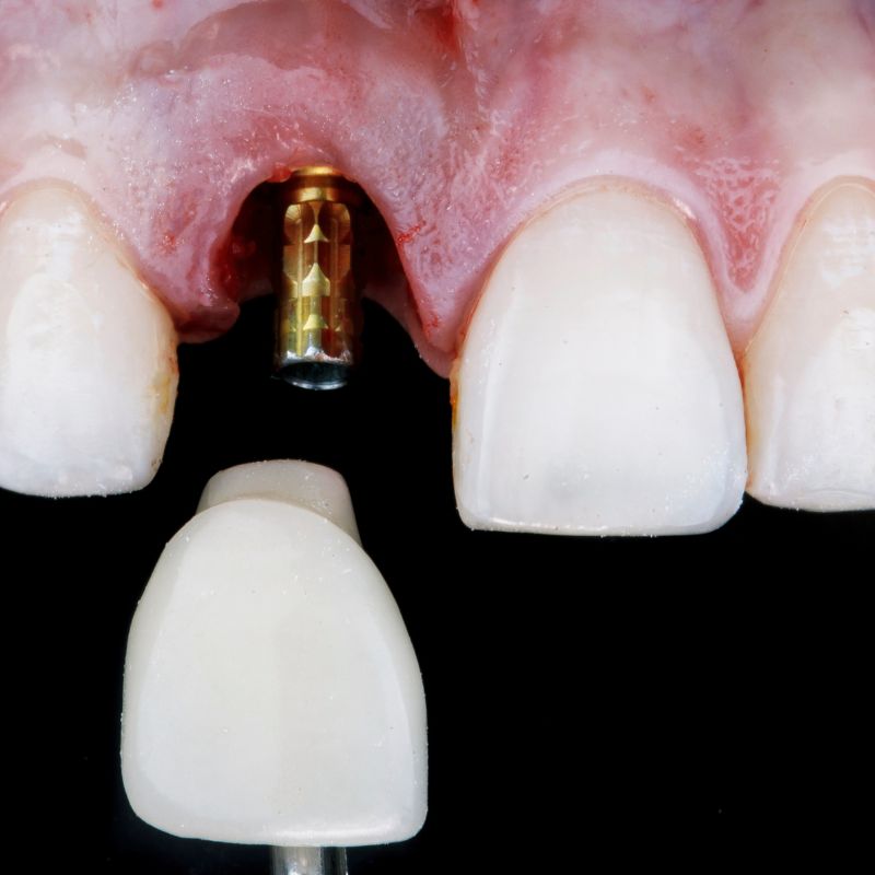 Dental mouth guard for protection